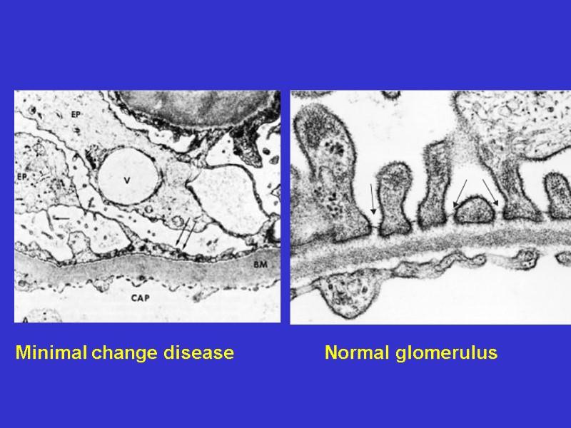 Normal glomerulus Minimal change disease